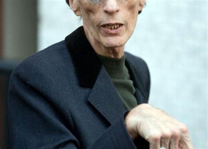 Bee Gees Star Robin Gibb Suffers Setback In His Cancer Treatment