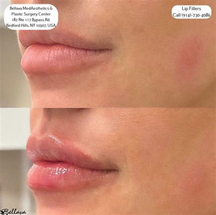 Bruce Jenner’s Plump New Lips: Has He Had Work Done?