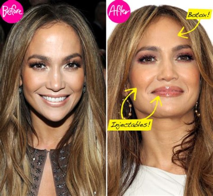 Has Jennifer Lopez Had Work Done? Expert Docs Say Yes! – Hollywood Life