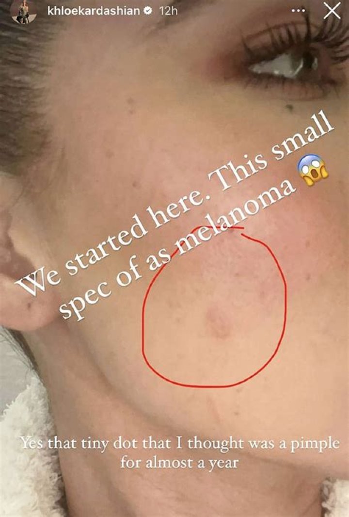 Her Melanoma Battle Explained & Updates – Hollywood Life