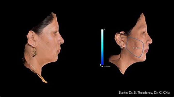 If Droopy Jowls Have You Down, There Is A New Painless Tightening Remedy