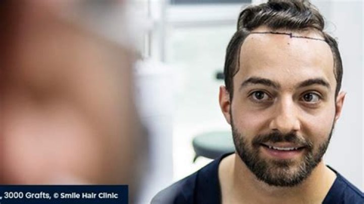 Istanbul Is the Best Place for Hair Restoration in Turkey for Hair Transplantation