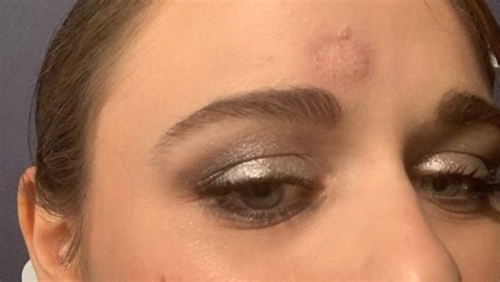 Joey King Proudly Shows Off Her Bruised Head After Being Hit By Patricia Arquette’s Golden Globe