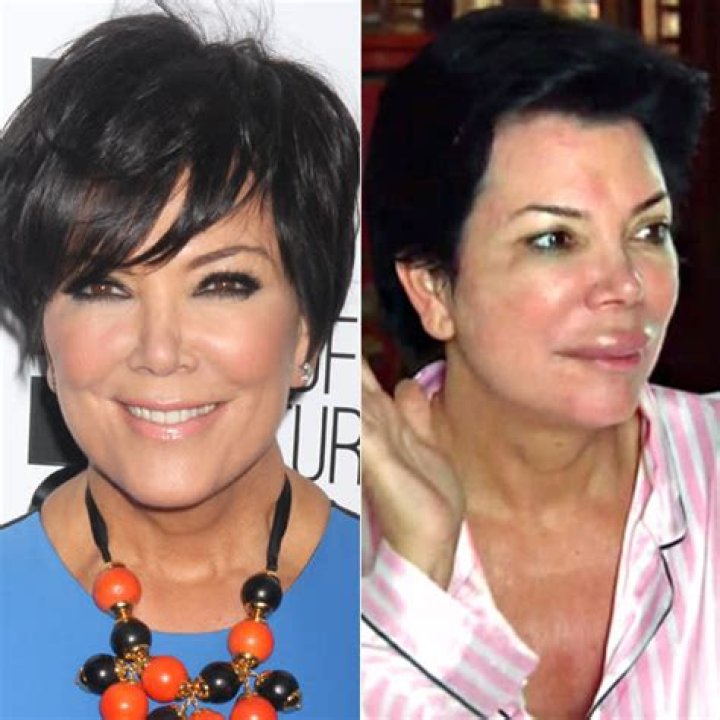 Kris Jenner's Gigantic Swollen Lips — Plastic Surgery Or Allergic Reaction?