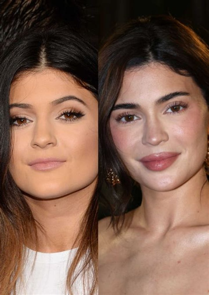 Kylie Jenner Addresses Her Lip Fillers & Face Surgery Speculation – Hollywood Life