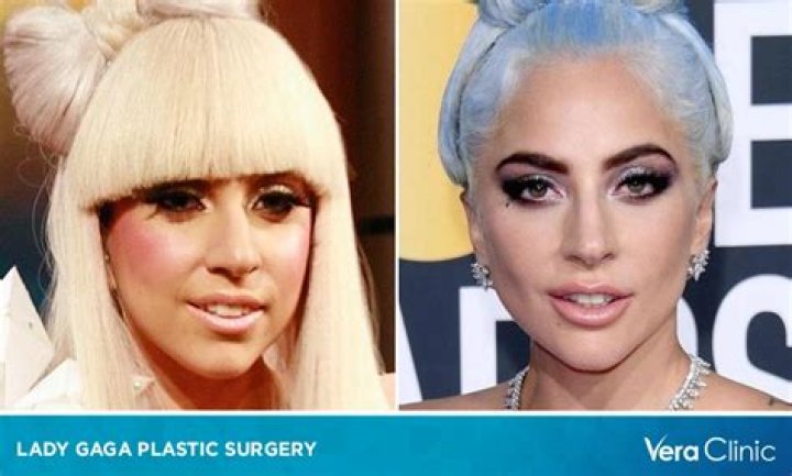 [PICS] Did Lady Gaga Get A Nose Job? Plastic Surgeon Speaks After ‘X Factor’ – Hollywood Life