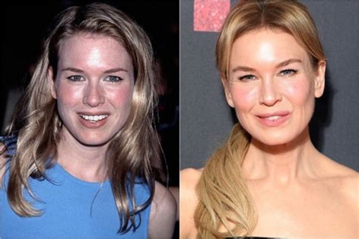 Renee Zellweger Lip Injections — The Actress Steps Out With Very Different Face – Hollywood Life