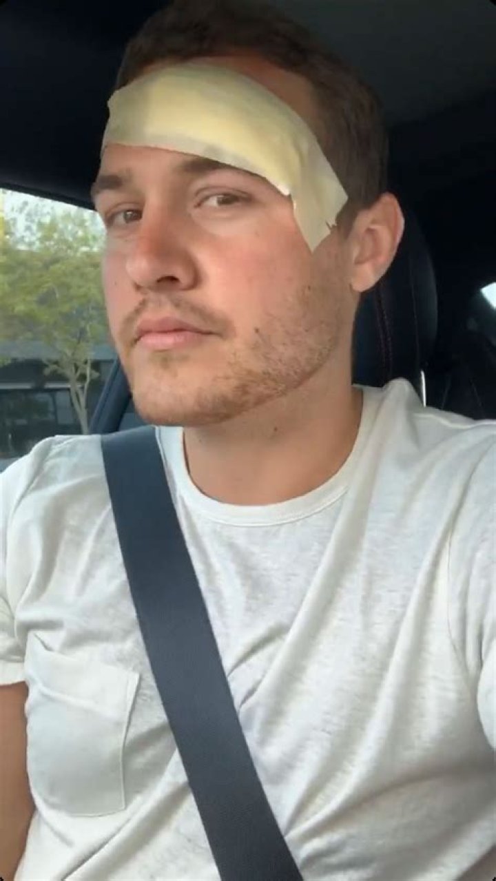 ‘The Bachelor’: Peter Weber’s Forehead Injury Explained — Why He Needed 22 Stitches